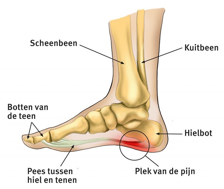 Zet Je Beste Beentje Voor In Het Herstel Van Hielspoor Fysiotherapie Berghuis